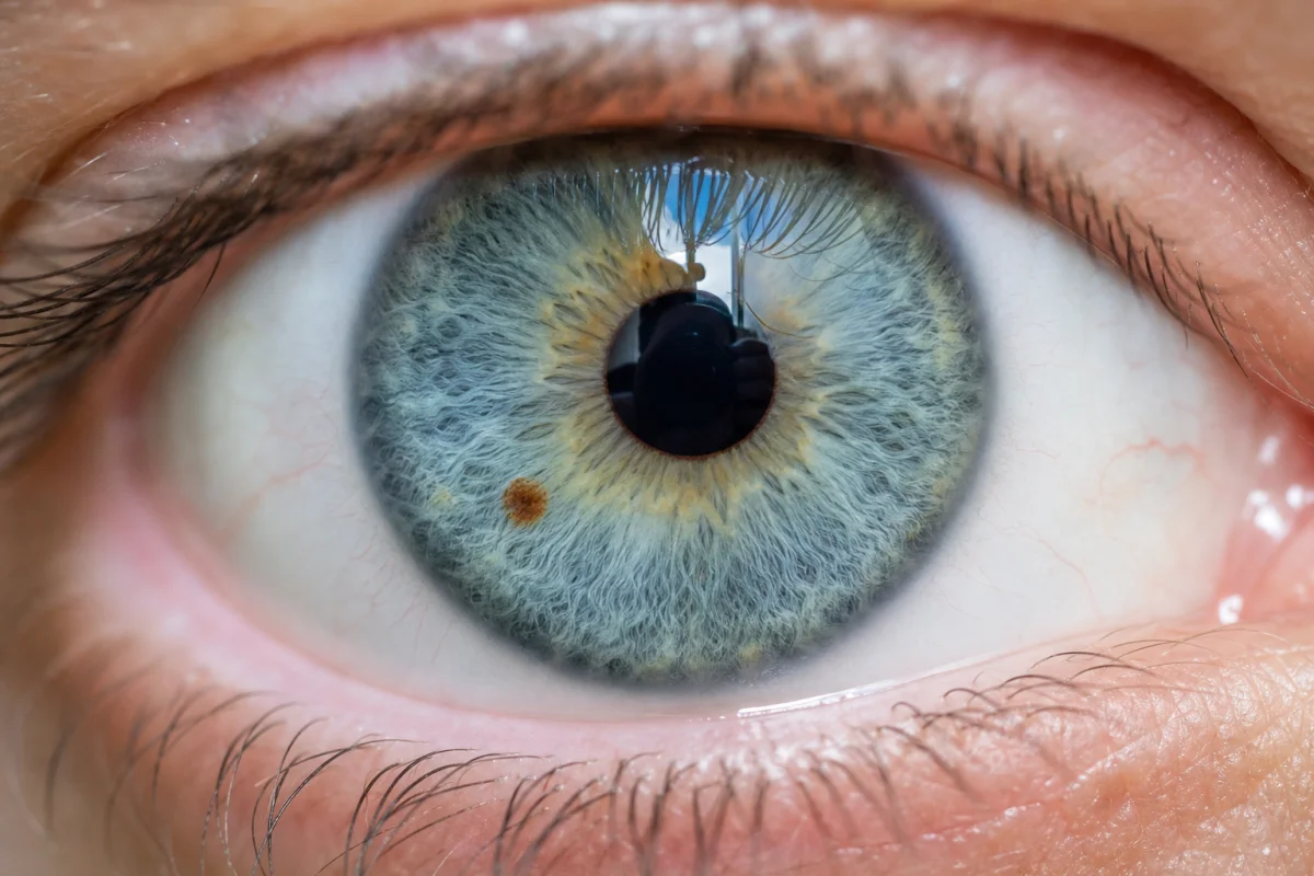grains de beauté dans l'oeil